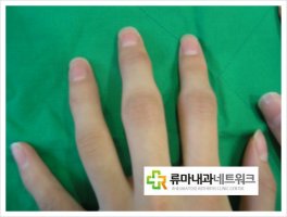 류마티스관절염초기증상2