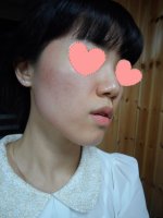 여드름레이저치료5