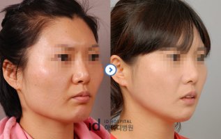 사각턱수술회복기간1