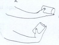 테니스엘보치료법5