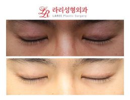 남자쌍꺼풀재수술2