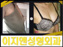 가슴성형 후기 사진3