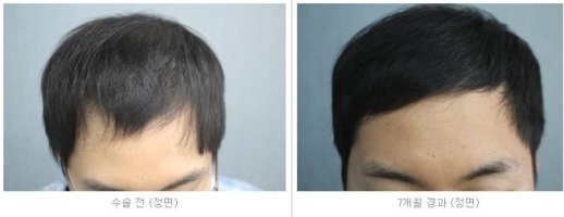 모발이식7개월6