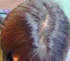 모발이식부작용3