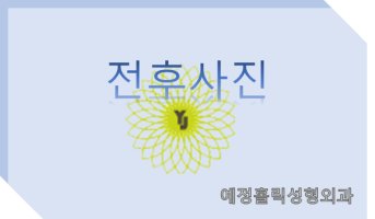 강남아큐스컬프2