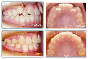 이빨교정비용4