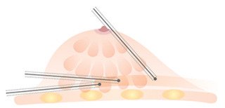 가슴지방이식비용1