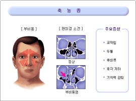 축농증에좋은음식3