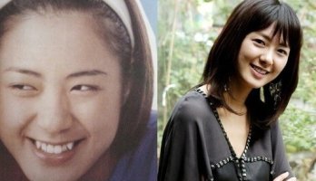 치아 교정 전후 사진2