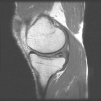 반월상연골파열4