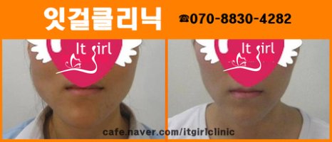 보톡스효과는며칠만에2