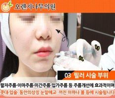 대전이마필러가격2