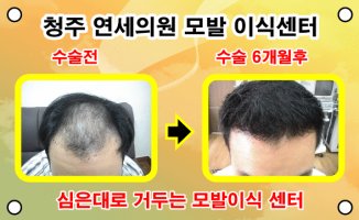 청주모발이식4