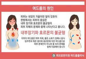 강남여드름한의원3