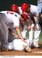 광대뼈골절수술4