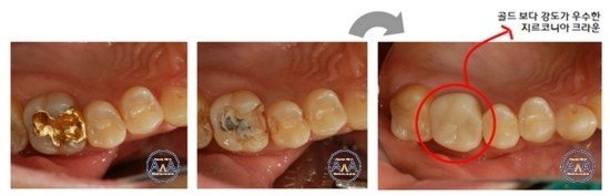 금니씌우는가격2