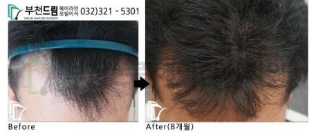 인천모발이식3