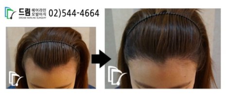 가르마모발이식5