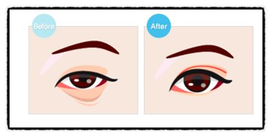 다크써클수술가격5