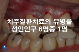 치주질환2