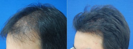 모발이식7개월1