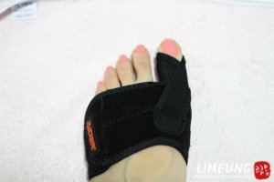 무지외반증교정3