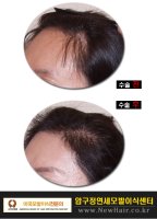 여성헤어라인비용2