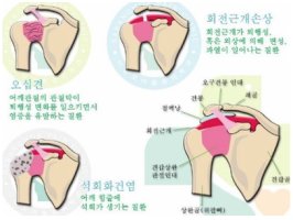 대구어깨통증2