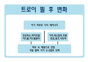 일산여드름압출1