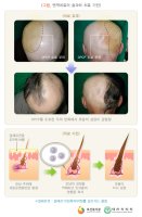 탈모치료법2