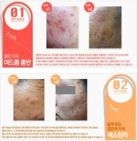 여드름빨간자국5