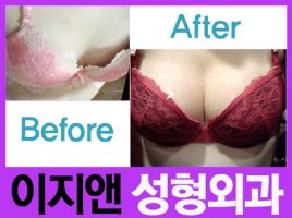 가슴성형 후기 사진2