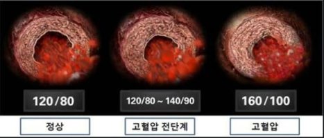 세계 고혈압의 날 _ 고혈압에 좋은 음식 / 운동