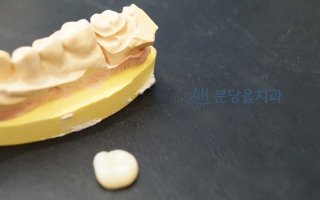 치과크라운1