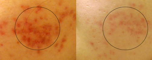 여드름자국치료1