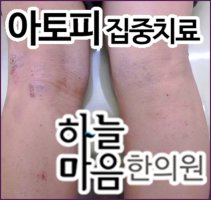 신생아아토피치료1