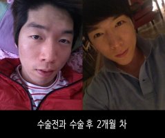 남자성형전후사진4