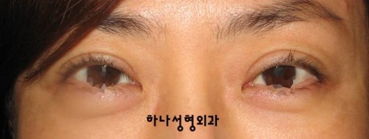쌍거풀재수술5