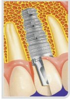 골이식임플란트2