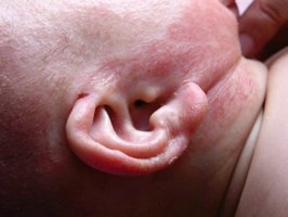 아토피증상사진1