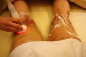 전신지방흡입비용3