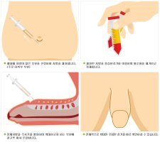남성수술부작용3