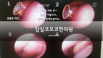 코물혹수술2