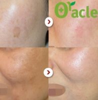 노원레이저토닝3