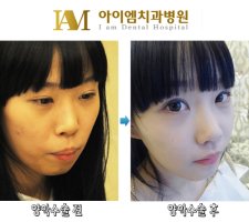 안면윤곽연예인2