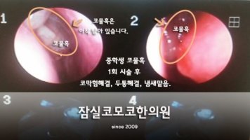 코물혹수술1