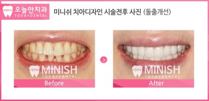 앞니치아성형2