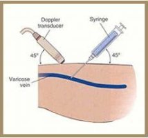 하지정맥류시술법6