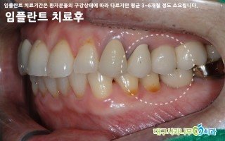 치과임플란트가격1